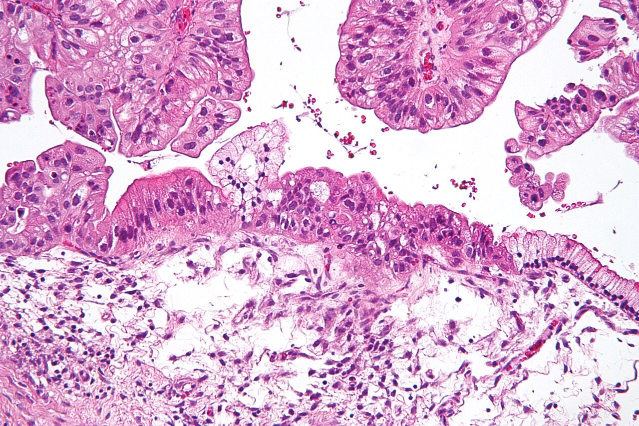 Ovarian Cancer Experts Flag Emergency Diagnoses as Barrier to Equitable Care