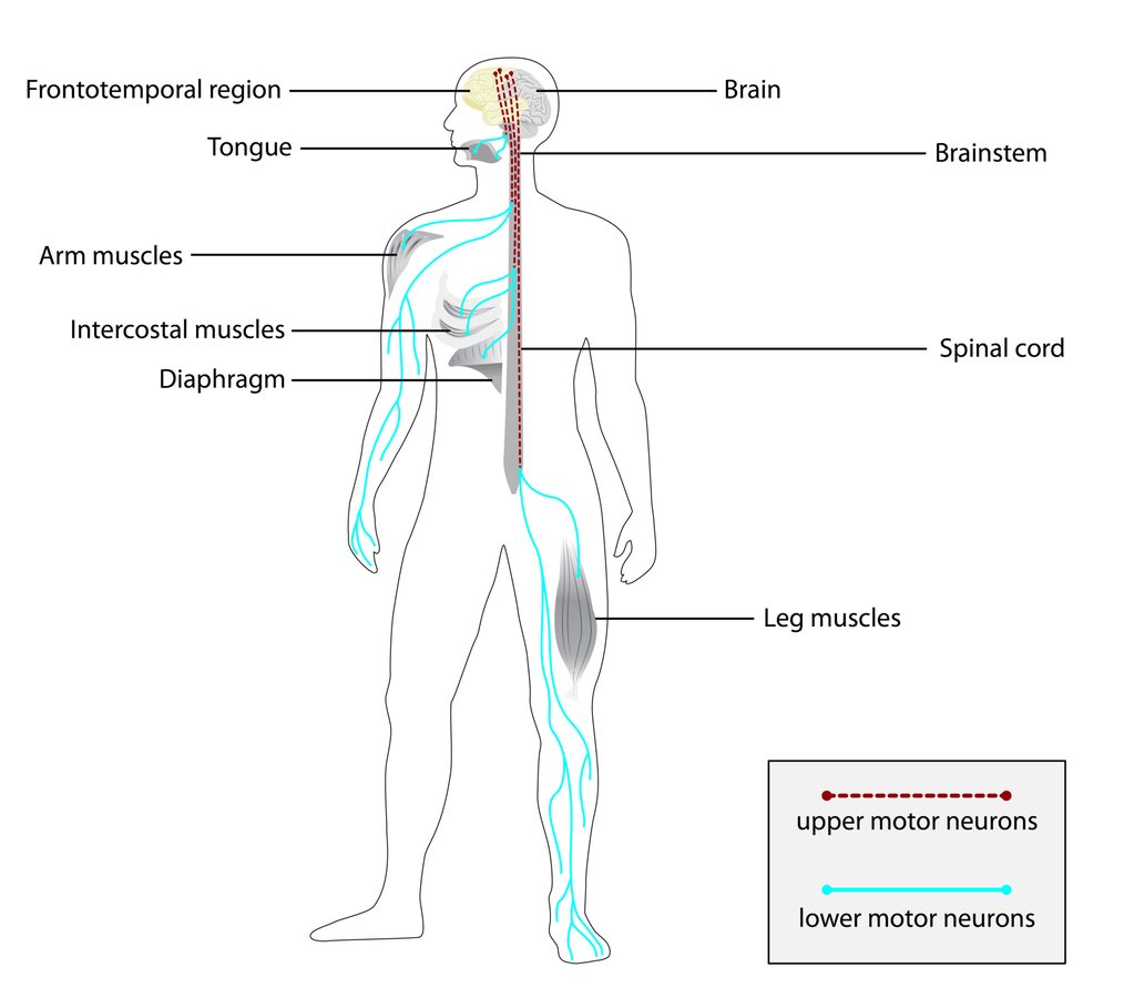 RNA Therapy Shows First Success in Rare Motor-Neuron Disease