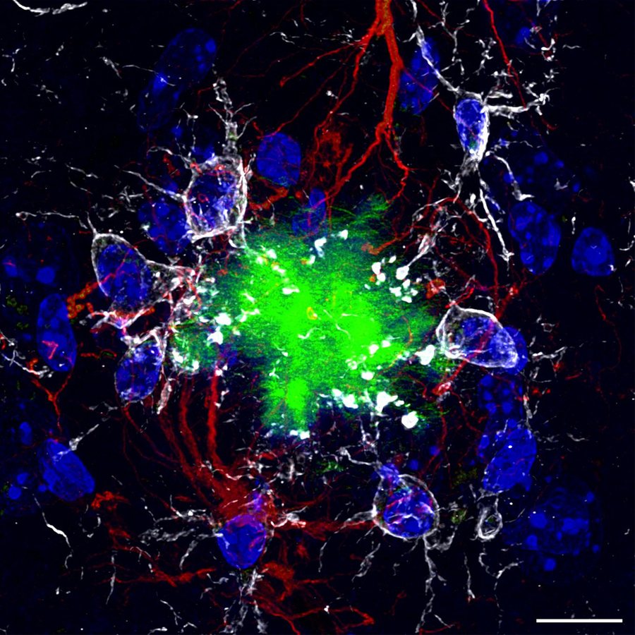Glucosamine Linked to Faster Alzheimer's Progression in Large Health-Record Study