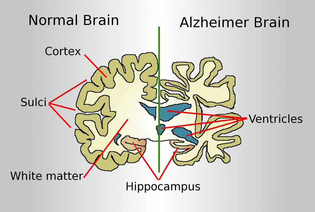 Alzheimer's Study Finds Disrupted DNA Organization in Brain Cells