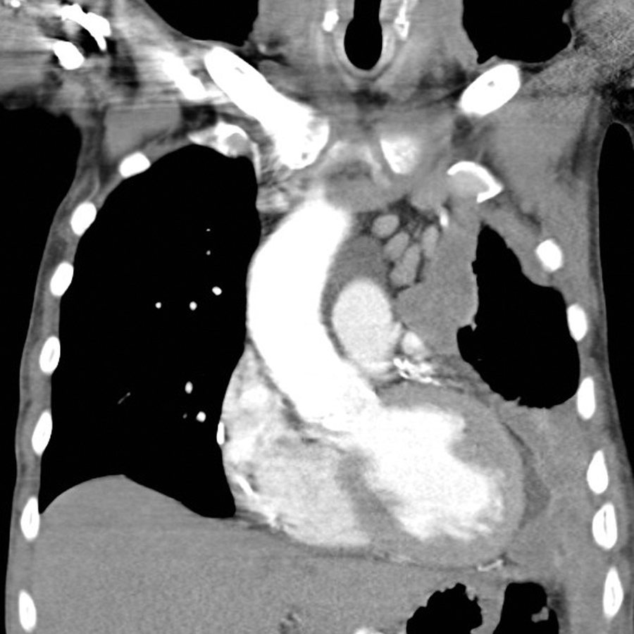 Experimental Drug Turns Mesothelioma's Defenses Against It