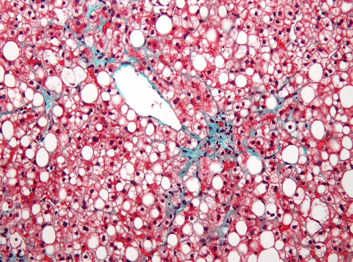 Common Plastic Linked to Fatty Liver Disease, Study Finds