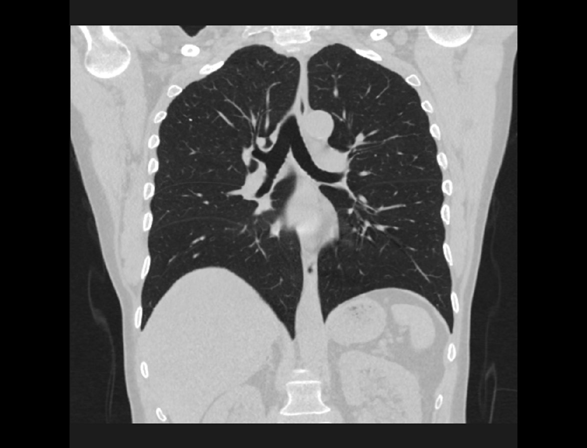 Pan-RAS Drug Shrinks Tumors in About a Third of Treated Lung Cancer Patients