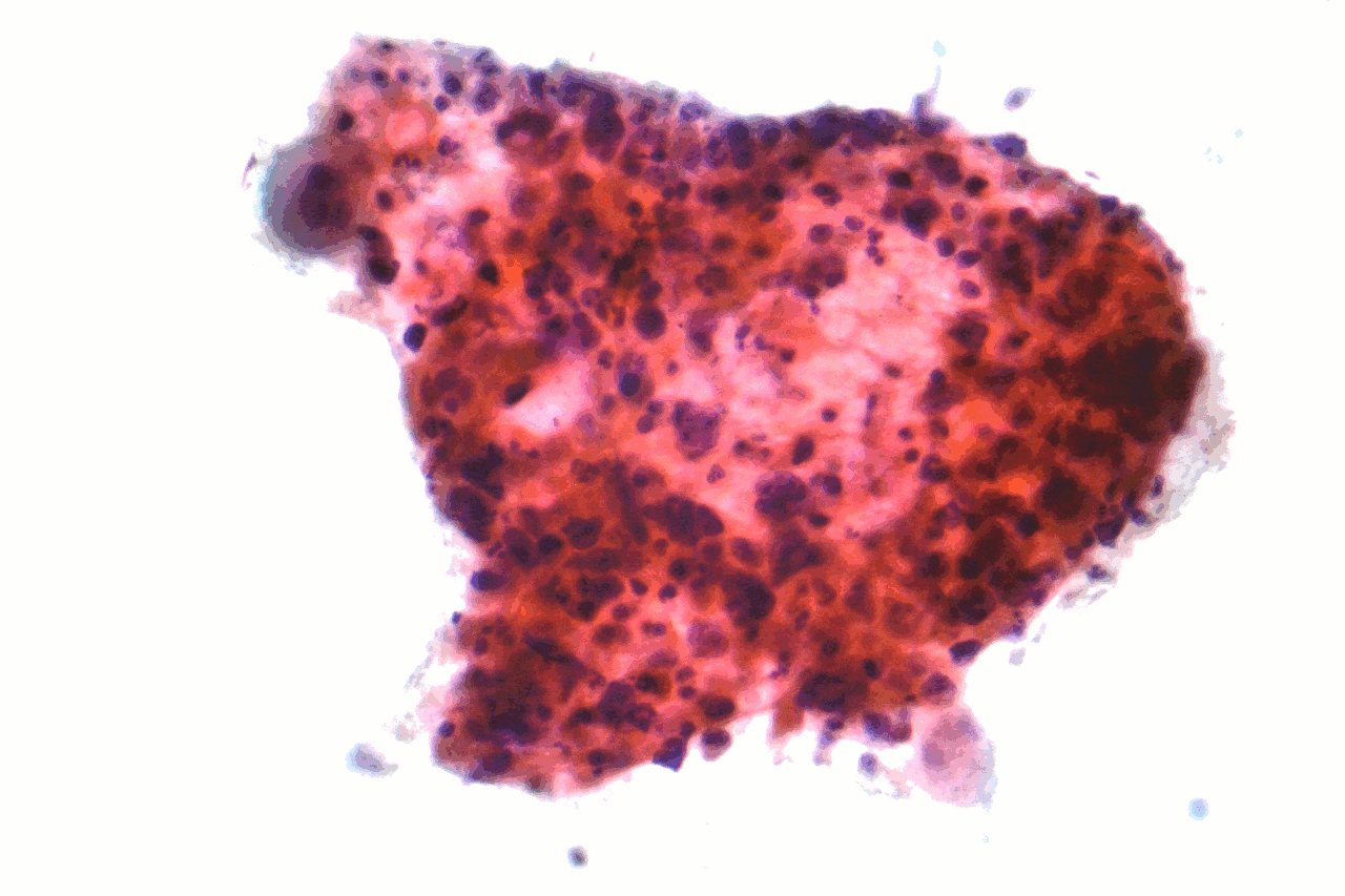 Neoadjuvant durvalumab with chemotherapy lets most lung cancer patients undergo surgery