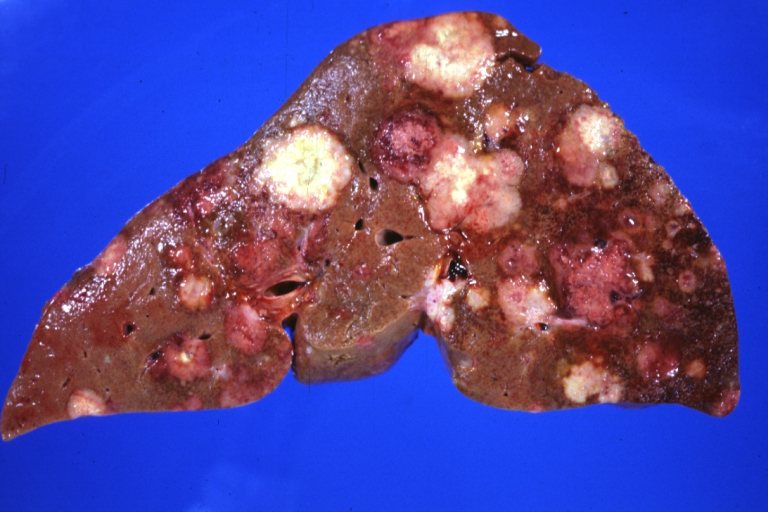 Experimental Drug Reverses Severe Fatty Liver Disease by Restoring Gut Health