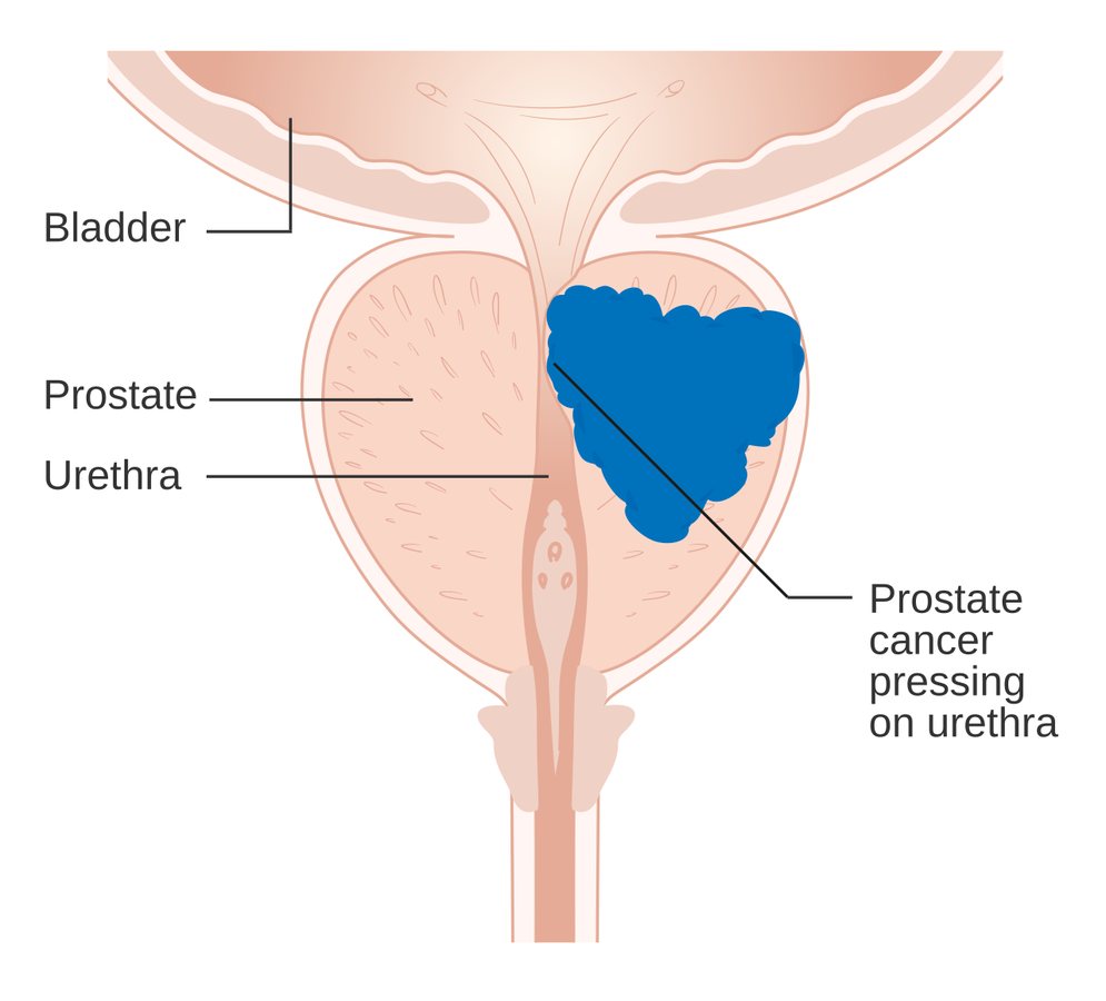 Researchers identify new vulnerability in treatment-resistant prostate cancer