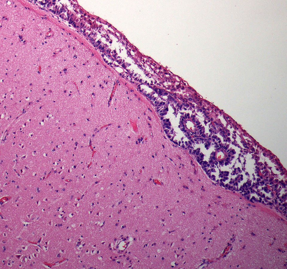 High-Dose Vitamin B3 Shows Early Promise Against Glioblastoma