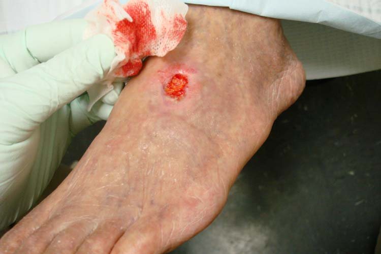 Peripheral Arterial Disease Is Systemic Atherosclerosis, Not a Benign Leg Condition