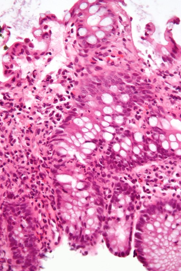 New Microscope Could Unlock Root Cause of Incurable Bowel Disease