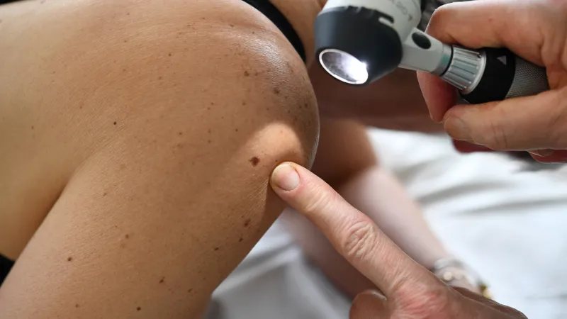Personalized mRNA vaccine shows promise in preventing melanoma recurrence