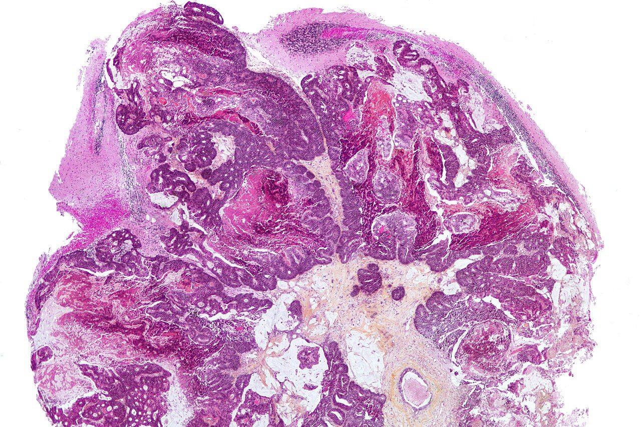 Smart Nanoparticles Illuminate and Destroy Hidden Brain Cancer Cells
