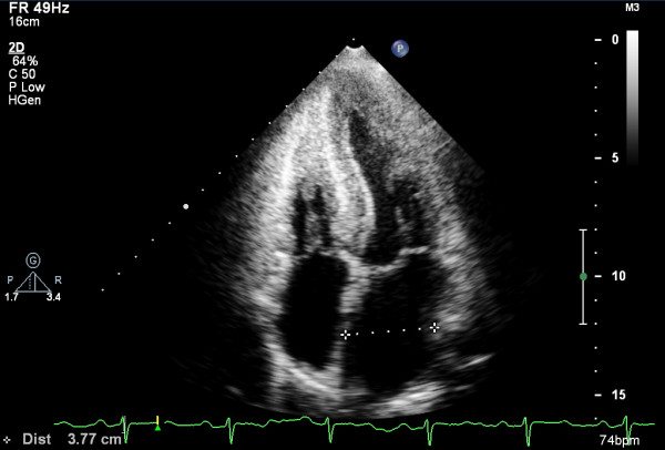 Eplontersen shows benefit in transthyretin amyloid cardiomyopathy only without stabilizers