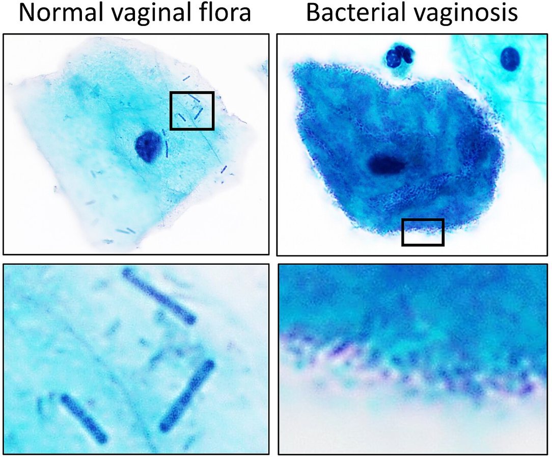 Australian Scientists Identify Two Causes of Recurrent Bacterial Vaginosis