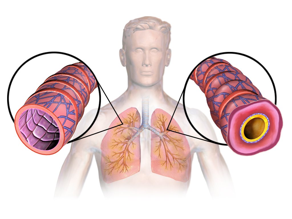 Severe Asthma Care Falls Short for Millions Despite Available Treatments